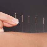 What Is Acupuncture? A Complete Beginner’s Guide