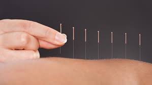 <strong>What Is Acupuncture? A Complete Beginner’s Guide</strong>